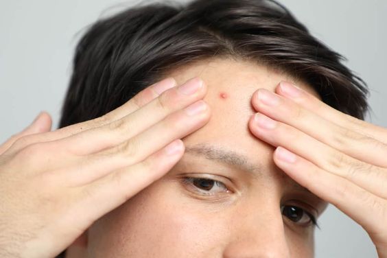 7 Skincare Pria paling Mujarab untuk Mengilangkan bekas Jerawat Dan kotoran lainnya di Wajah