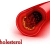 Menghadapi Ancaman Kolesterol pada Usia Muda: Pentingnya Kesadaran akan Dampak Jangka Panjang