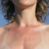 Rekomendasi Skincare untuk Mengatasi Kulit Sunburn